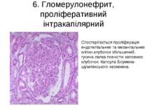 6. Гломерулонефрит, проліферативний інтракапілярний Спостерігається проліфера...