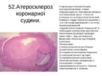 52.Атеросклероз коронарної судини. Атеросклеротическая бляшка коронарной арте...