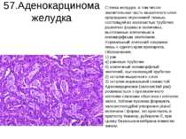 57.Аденокарцинома желудка Стенка желудка, в том числе значительная часть мыше...
