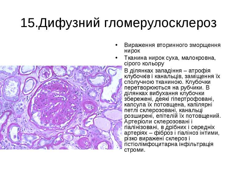 15.Дифузний гломерулосклероз Вираження вторинного зморщення нирок Тканина нир...
