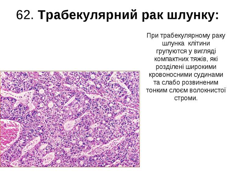 62. Трабекулярний рак шлунку: При трабекулярному раку шлунка клітини групуютс...
