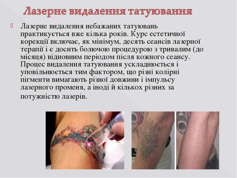 Лазерне видалення небажаних татуювань практикується вже кілька років. Курс ес...