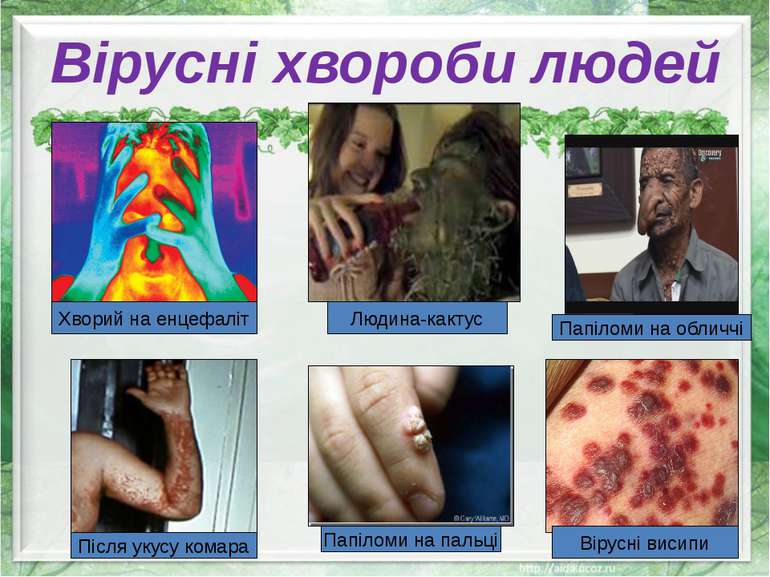 Вірусні хвороби людей Хворий на енцефаліт Людина-кактус Після укусу комара Па...