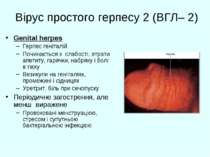 Вірус простого герпесу 2 (ВГЛ– 2) Genital herpes Герпес геніталій Починається...