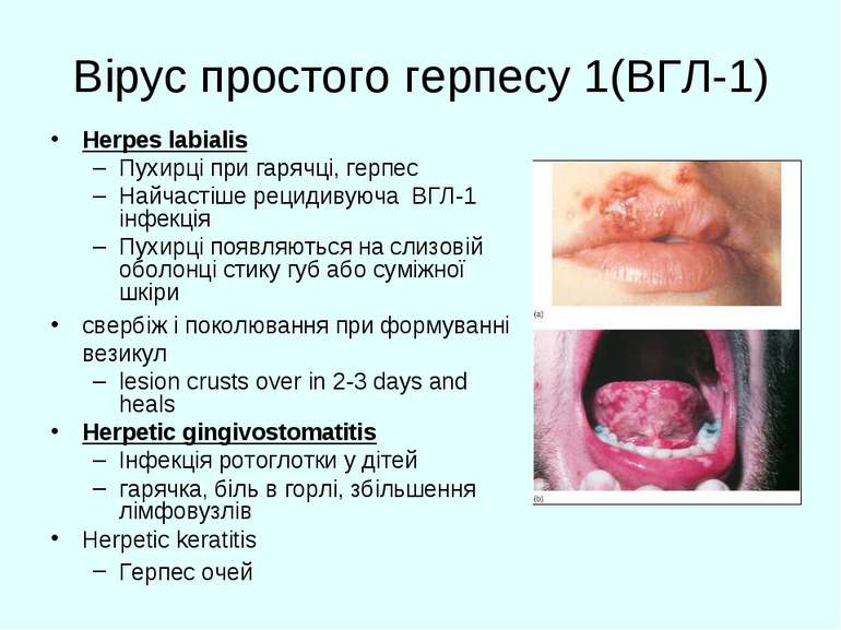 Вірус простого герпесу 1(ВГЛ-1) Herpes labialis Пухирці при гарячці, герпес Н...