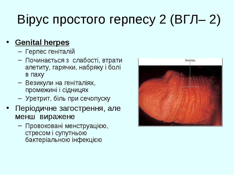Вірус простого герпесу 2 (ВГЛ– 2) Genital herpes Герпес геніталій Починається...