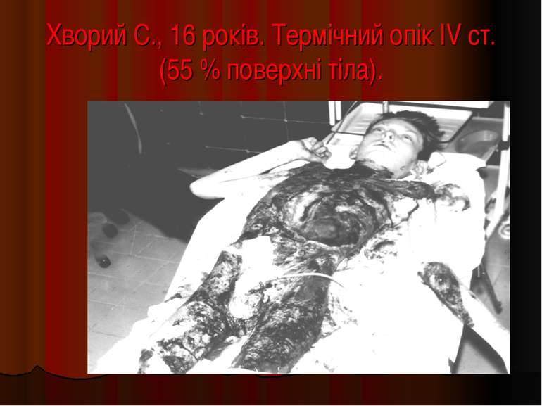 Хворий С., 16 років. Термічний опік IV ст. (55 % поверхні тіла).