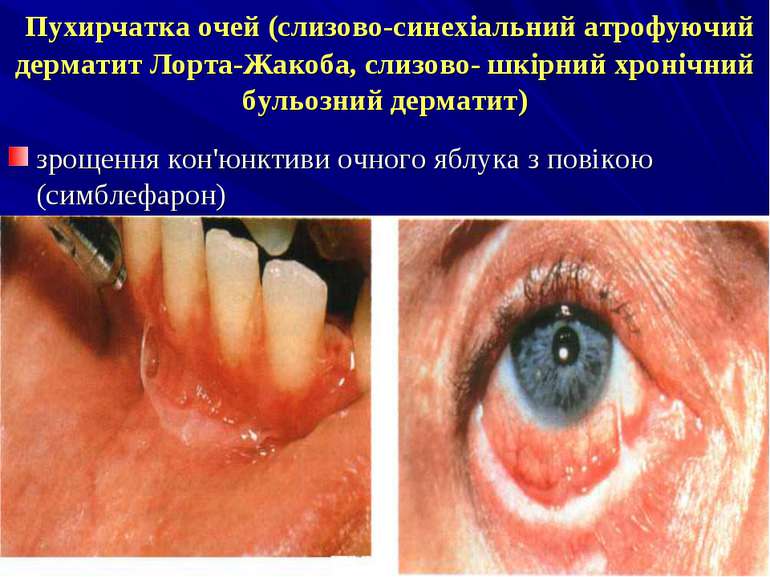 Пухирчатка очей (слизово-синехіальний атрофуючий дерматит Лорта-Жакоба, слизо...