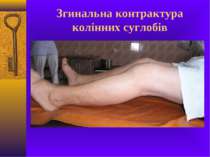 Згинальна контрактура колінних суглобів