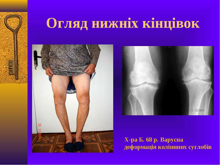 Огляд нижніх кінцівок Х-ра Б. 68 р. Варусна деформація коліннних суглобів