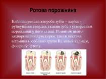 Найпоширеніша хвороба зубів – карієс - руйнування твердих тканин зуба з утвор...