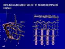Методика одномірної ЕхоКС -М- режим (аортальний клапан)