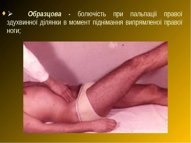 Ø     Образцова - болючість при пальпації правої здухвинної ділянки в момент ...