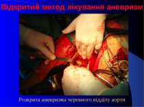 Відкритий метод лікування аневризм Розкрита аневризма черевного відділу аорти