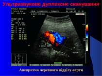 Ультразвукове дуплексне сканування Аневризма черевного відділу аорти
