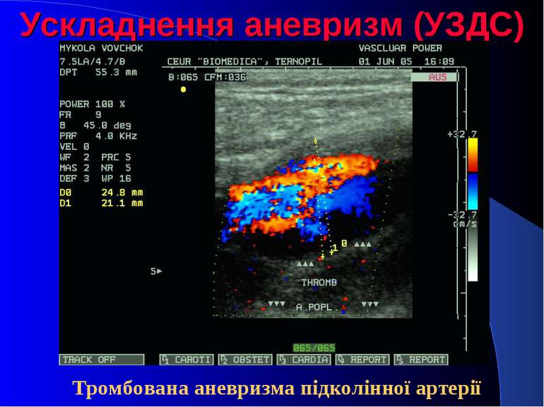 Ускладнення аневризм (УЗДС) Тромбована аневризма підколінної артерії
