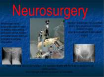Neurosurgery Neurosurgery is the surgical discipline focused on treating thos...