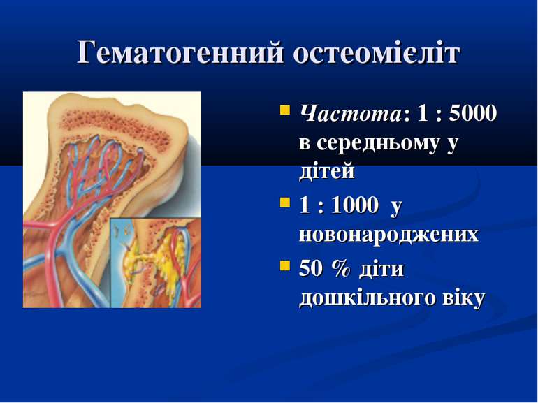 Гематогенний остеомієліт Частота: 1 : 5000 в середньому у дітей 1 : 1000 у но...