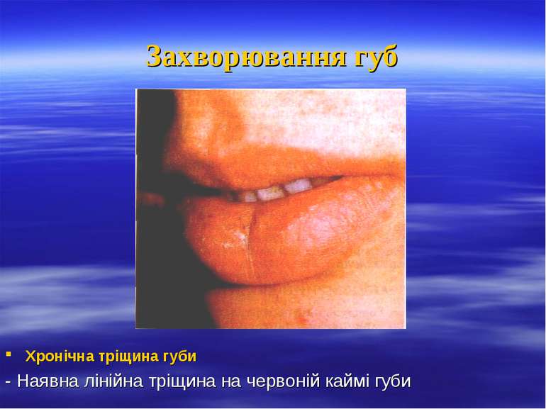 Захворювання губ Хронічна тріщина губи - Наявна лінійна тріщина на червоній к...