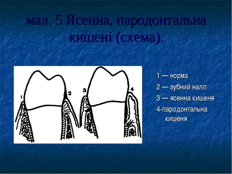 мал. 5 Ясенна, пародонтальна кишені (схема). 1 — норма 2 — зубний наліт 3 — я...