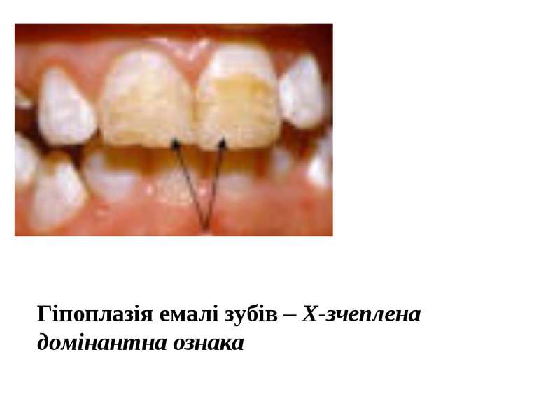 Гіпоплазія емалі зубів – Х-зчеплена домінантна ознака