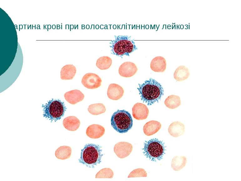 Картина крові при волосатоклітинному лейкозі