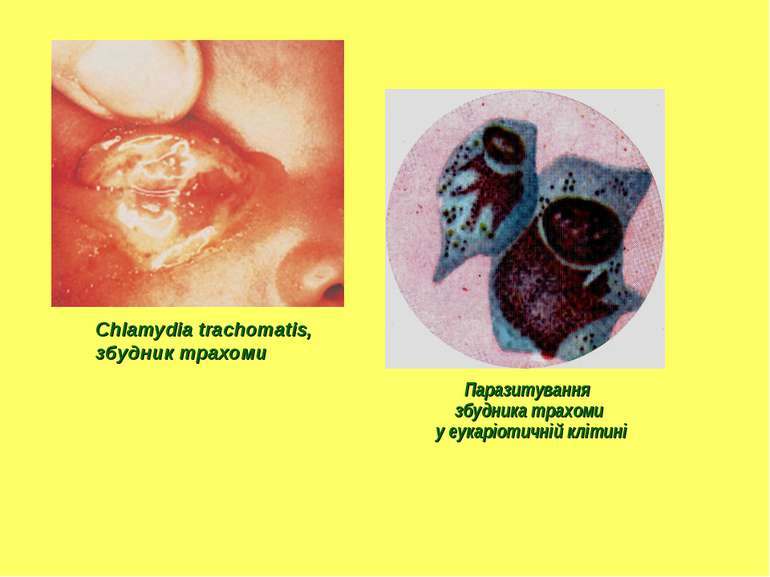 Chlamydia trachomatis, збудник трахоми Паразитування збудника трахоми у еукар...