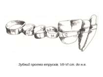 Зубний протез етрусків. VII-VI ст. до н.е.