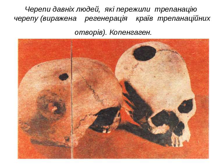 Черепи давніх людей, які пережили трепанацію черепу (виражена регенерація кра...