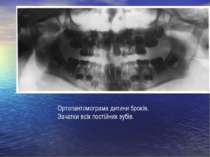 Ортопантомограма дитини 5років. Зачатки всіх постійних зубів.