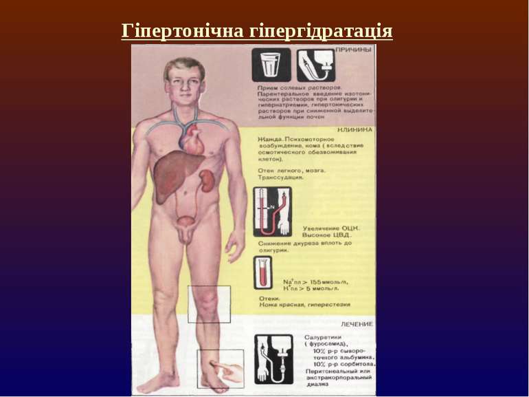 Гіпертонічна гіпергідратація