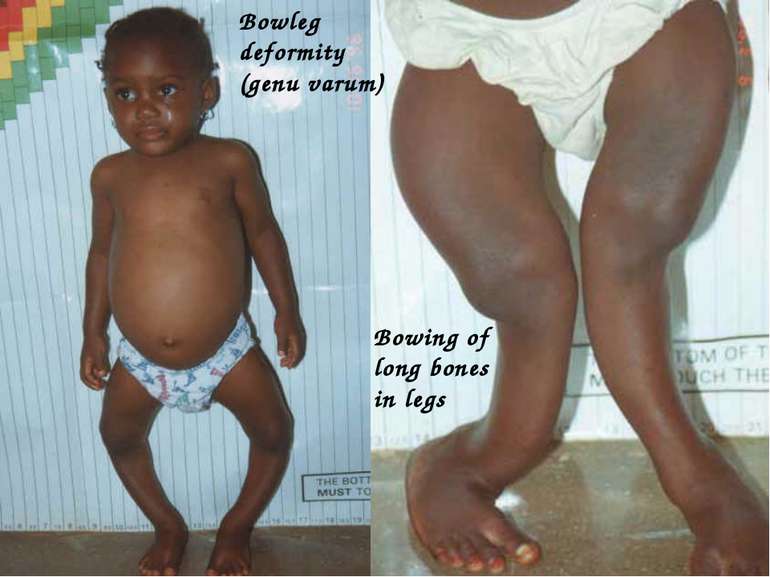 Bowing of long bones in legs Bowleg deformity (genu varum)