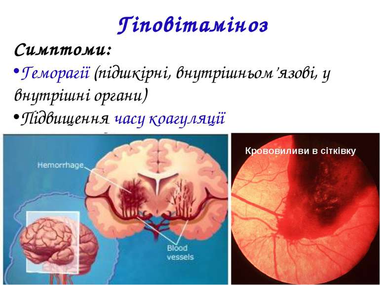 Гіповітаміноз Симптоми: Геморагії (підшкірні, внутрішньом’язові, у внутрішні ...
