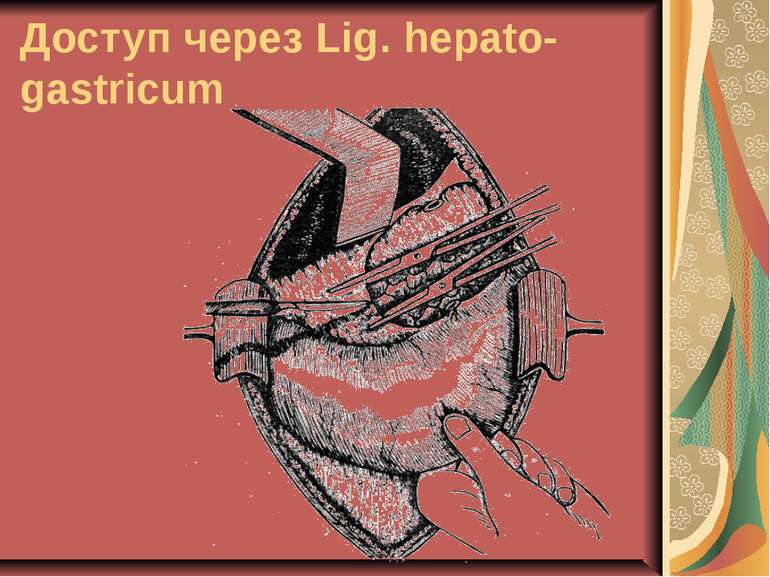 Доступ через Lig. hepato-gastricum