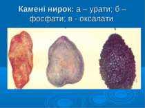 Камені нирок: а – урати; б – фосфати; в - оксалати