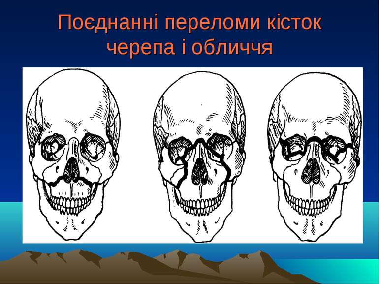 Поєднанні переломи кісток черепа і обличчя