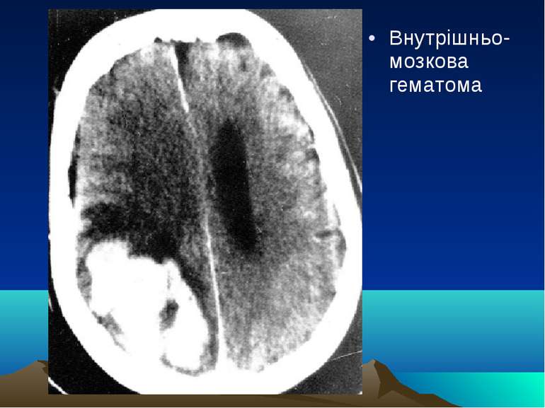 Внутрішньо-мозкова гематома