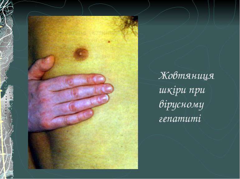 Жовтяниця шкіри при вірусному гепатиті