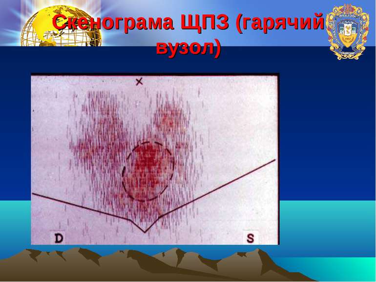 Скенограма ЩПЗ (гарячий вузол)