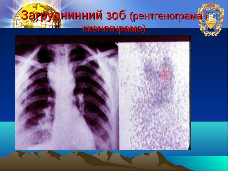Загруднинний зоб (рентгенограма і скеногнрама)