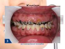 Карієс  зміна кольору емалі, зубний біль, підвищена чутливість, на більш глиб...