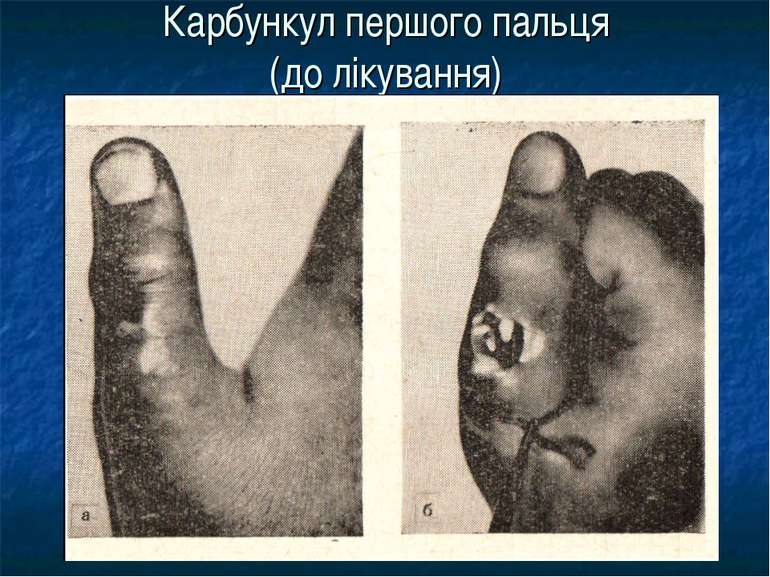 Карбункул першого пальця (до лікування)