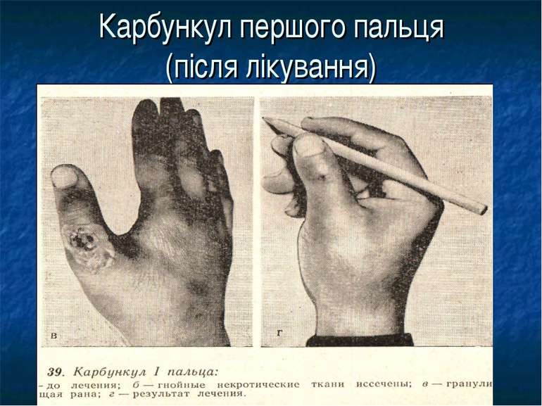 Карбункул першого пальця (після лікування)