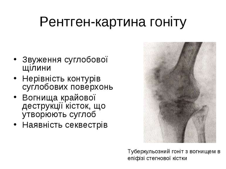 Рентген-картина гоніту Звуження суглобової щілини Нерівність контурів суглобо...