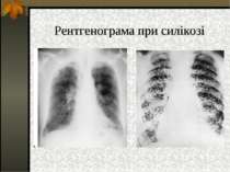 Рентгенограма при силікозі