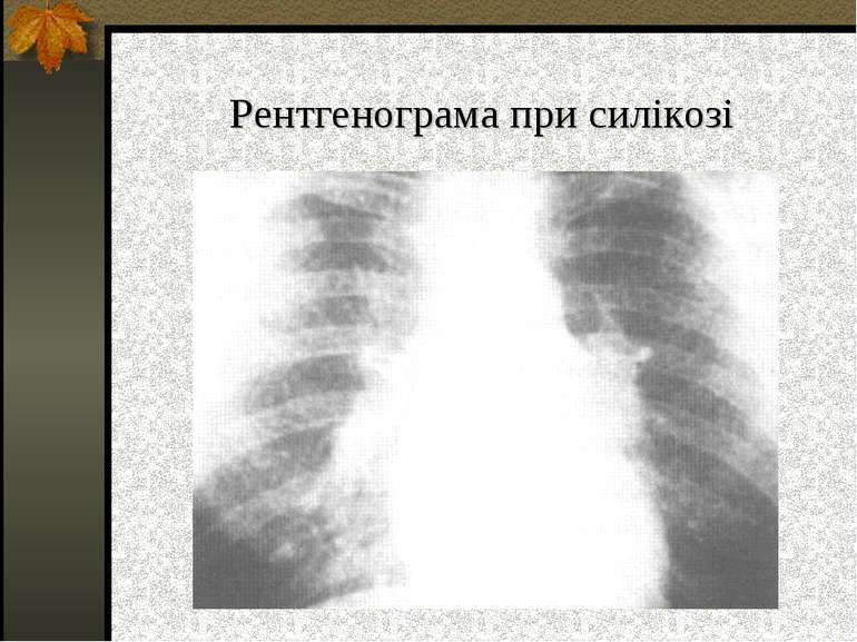 Рентгенограма при силікозі