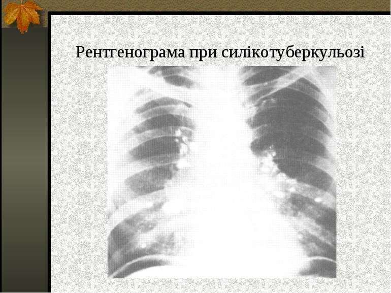 Рентгенограма при силікотуберкульозі