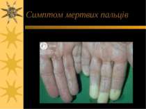 Симптом мертвих пальців
