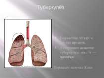Поражение лёгких и других органов. Устаревшее название туберкулёза лёгких — ч...