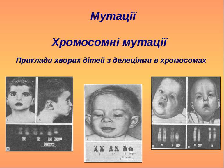 Хромосомні мутації Мутації Приклади хворих дітей з делеціями в хромосомах